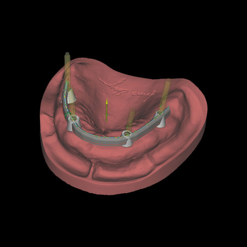 Módulo de software de CAD - Bars - Zirkonzahn - de creación de prótesis dentales / FAO / de laboratorio dental