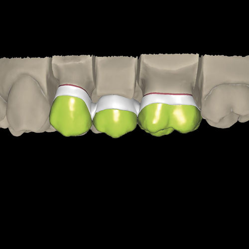 Módulo de software de CAD - Overpress crowns and overpress bridges - Zirkonzahn - de creación de prótesis dentales / FAO / de laboratorio dental