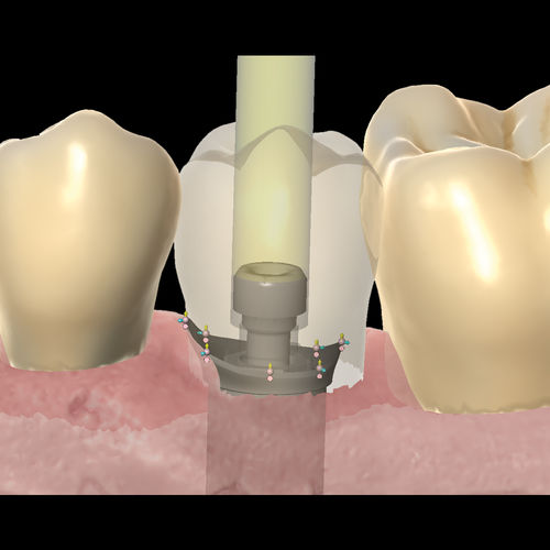 módulo de software de creación de prótesis dentales - Zirkonzahn
