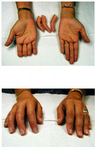 Prótesis estética esterna de dedo - Boston Orthotics + Prosthetics - parcial / para adulto