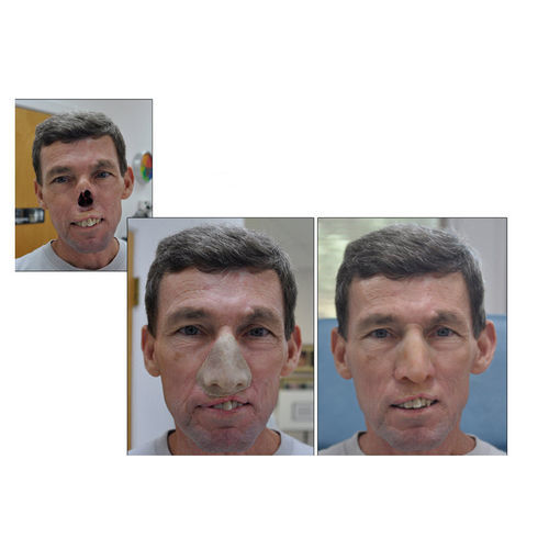 Prótesis estética esterna nasal - RealLifeSkin™ - RealLifeSkin - para adulto