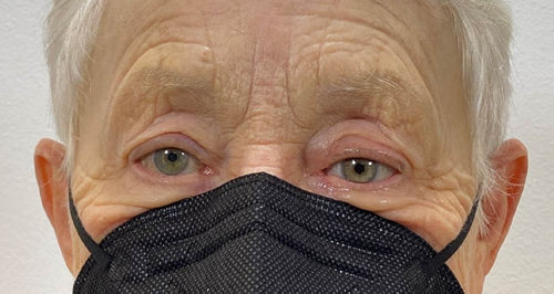 Prótesis estética esterna ocular - Scleral Shells - The Anaplastology Clinic - para adulto