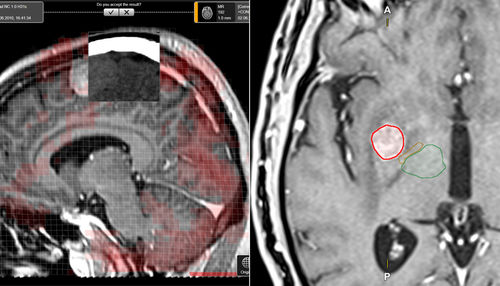 Software de planificación de tratamiento - Elements - Brainlab - médico / de oncología / automatizado