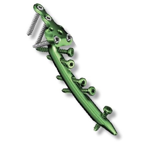 Clavo intramedular para radio - Charfix2 - ChM - fijación distal / de titanio