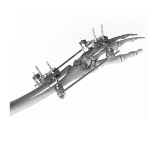 Fijador externo para muñeca - 206301 - SOFEMED International - tubular / para adulto