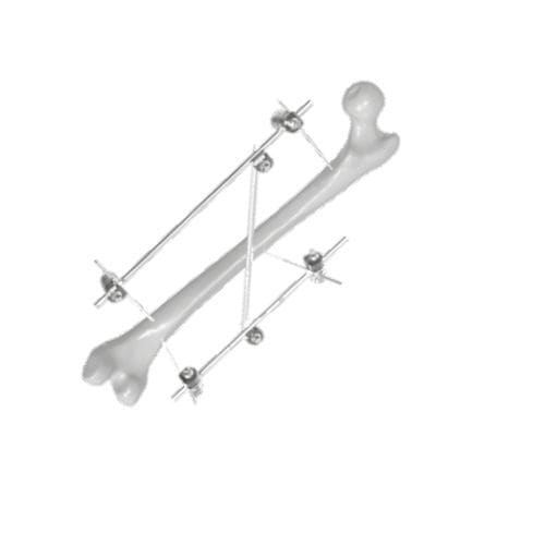Fijador externo para fémur - 206307 - SOFEMED International - tubular / para adulto