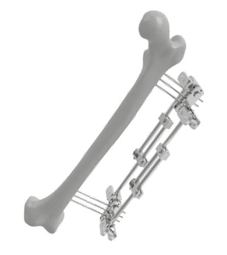 Fijador externo para fémur - 201502 - SOFEMED International - tubular / para adulto
