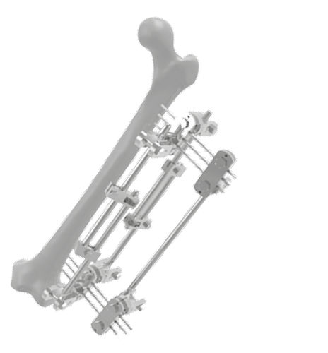 Fijador externo para fémur - 201503 - SOFEMED International - tubular / para adulto