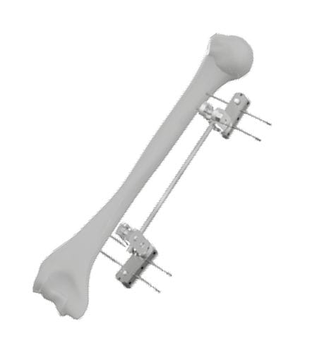 Fijador externo para húmero - 201541 - SOFEMED International - tubular / para adulto