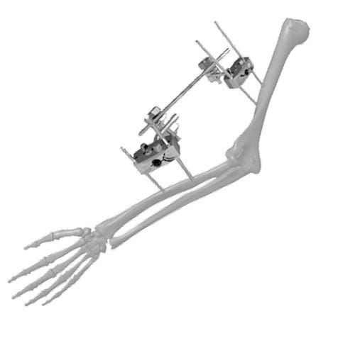 Fijador externo para codo - 206303 - SOFEMED International - tubular / para adulto