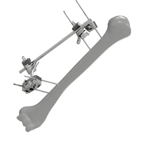 Fijador externo para húmero - 206304 - SOFEMED International - tubular / para adulto