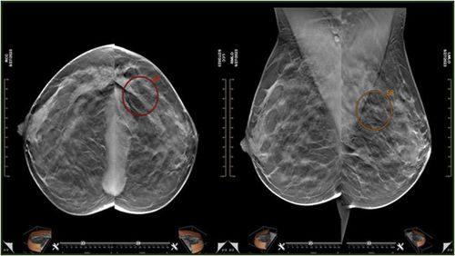 Software de CAD - MEDI-FUTURE - para mamografía / de oncología / para detección del cáncer de mama