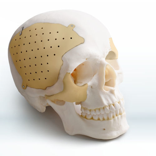 Implante craneal a medida - Recranio™ - Medprin Biotech