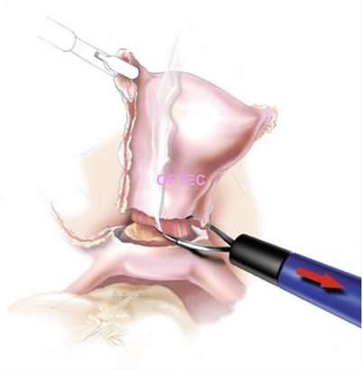 Electrodo laparoscópico - LapLoop  - OPTEC Endoscopy Systems - de bucle / monopolar