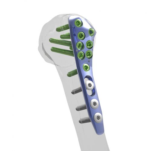 Placa de compresión para húmero - Alians™ - Enovis Surgical - porción proximal / bloqueada / metálica