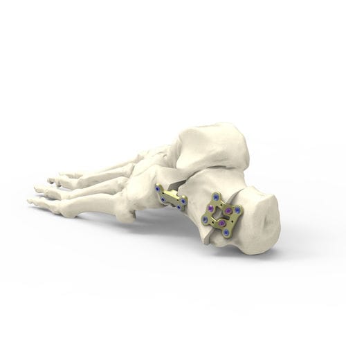 Placa de osteotomía para calcáneo - FDTSDN1 - Newclip Technics - metálica