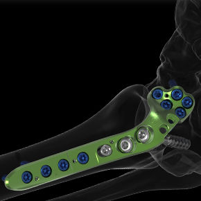 Placa de artrodesis para articulación metatarsofalángica - ACTIV FUSE - Newclip Technics - anterolateral / metálica