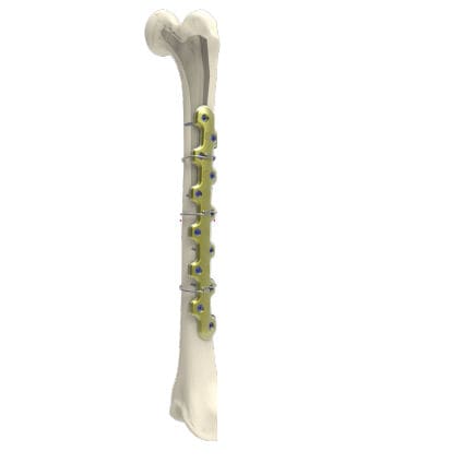 Placa de osteotomía para fémur - PERIACTIV - Newclip Technics - bloqueada / metálica