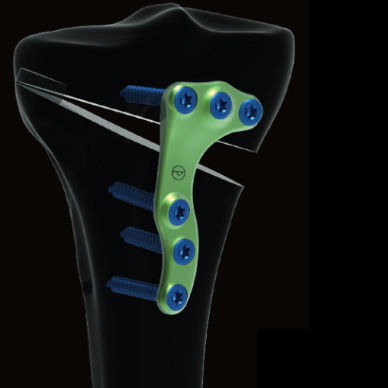Placa de osteotomía para tibia - Activmotion S   - Newclip Technics - porción proximal / lateral / metálica