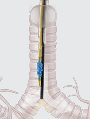 Bloqueador endobronquial de dos luces - COOK Medical - de una luz