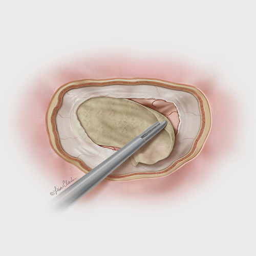 Prótesis de sustitución de duramadre pequeña submucosa intestinal porcina - Biodesign® - COOK Medical