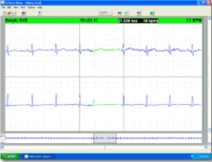 Software de monitorización - Trillium Silver™ - Forest Medical - de análisis / médico / para Holter cardíaco