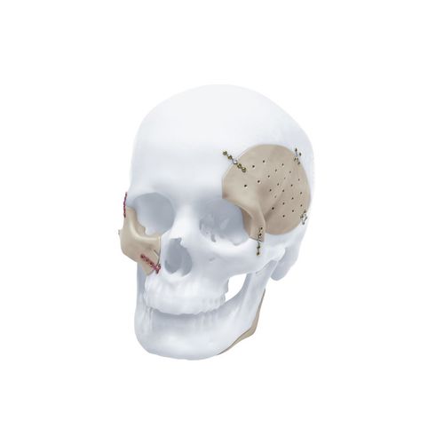 Implante craneal a medida - TRUMATCH™ - Depuy Synthes