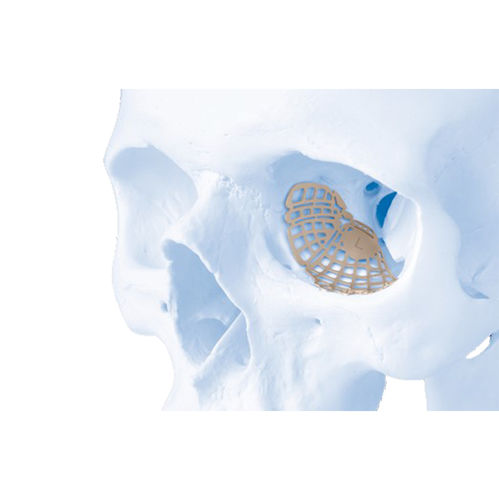 Implante periorbital no reabsorbible - MatrixORBITAL™ - Depuy Synthes