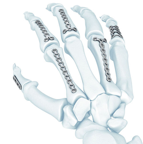 Placa de compresión para metacarpo - LCP® - Depuy Synthes - bloqueada / metálica