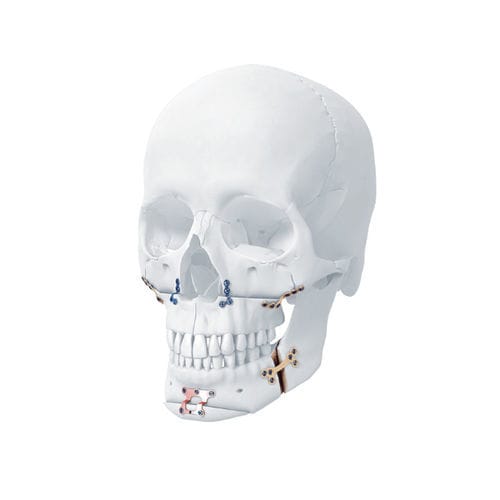Placa de compresión para mandíbula - MatrixORTHOGNATHIC™ - Depuy Synthes - para maxilares / bloqueada / metálica