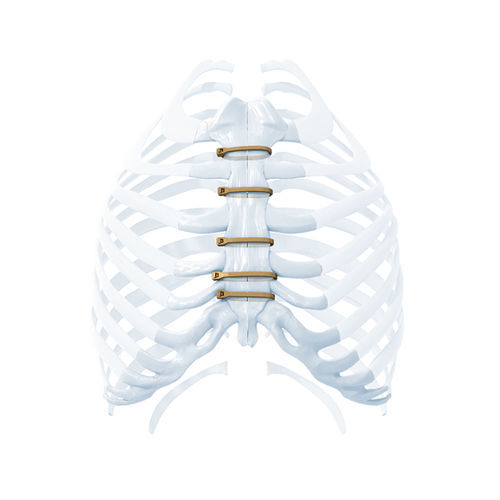 Cierre esternal tipo cerclaje - ZIPFIX™ - Depuy Synthes - monofilamento metálico
