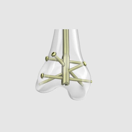 Clavo intramedular para fémur - RFN-ADVANCED™ - Depuy Synthes - fijación distal / metálico