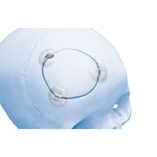 Sistema de fijación craneal reabsorbible - RAPIDSORB™  - Depuy Synthes