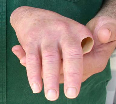 Prótesis estética esterna de mano - Aesthetic Prosthetics - parcial / para adulto