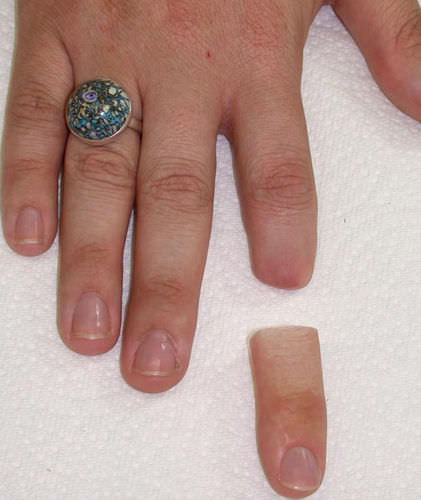 Prótesis estética esterna de dedo - Aesthetic Prosthetics - para adulto