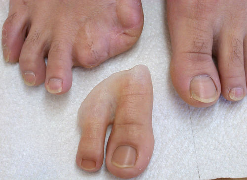 Prótesis estética esterna dedo del pie - Aesthetic Prosthetics - para adulto