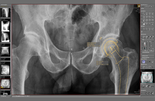 Módulo de software de planificación - dicomPACS® Prosthesis  - OR Technology - Oehm und Rehbein - para imágenes médicas / para cirugía ortopédica