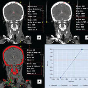 Módulo de software médico - Aquarius iNtuition - TeraRecon - para imagen cerebral / de diagnóstico / con sistema de seguimiento