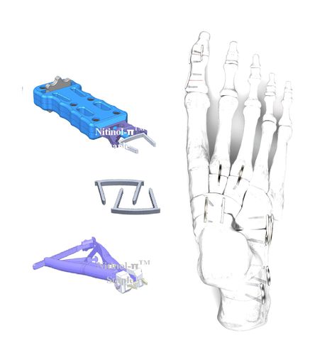 Grapa ortopédica para fragmentos óseos pequeños - HJ-π Staple - Health-Joy Medical - para hallux valgus / para artrodesis de la articulación interfalángica del pie / para osteotomía de calcáneo de Evans