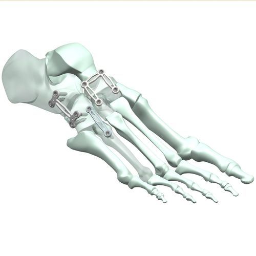 Placa de artrodesis para articulación tarsometatarsiana - HJ-Expandable 01 - Health-Joy Medical - lateral / porción distal / dorsal