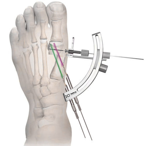 Kit de instrumentos para cirugía mínimamente invasiva del antepié - HJ-Bunion  - Health-Joy Medical