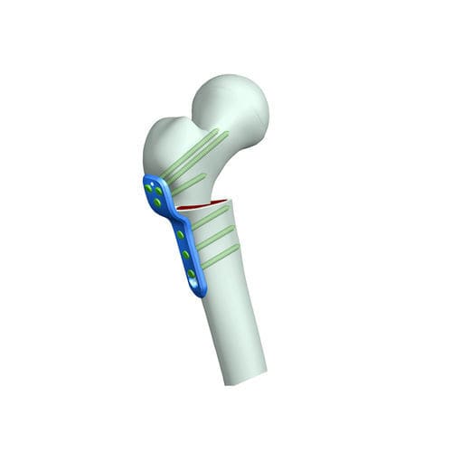 Placa de osteotomía para fémur - HJ-PediHLCP110 - Health-Joy Medical - porción proximal / porción distal / bloqueada