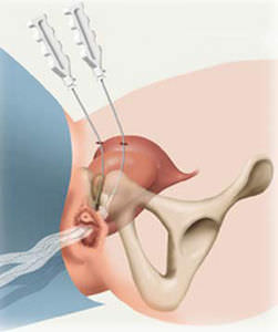 Banda de reconstrucción para la incontinencia urinaria - SPARC™ - American Medical Systems - vía suprapúbica / para mujer