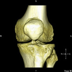 Software de creación de prótesis de rodilla - iFit® - ConforMIS - de anatomía / para cirugía ortopédica