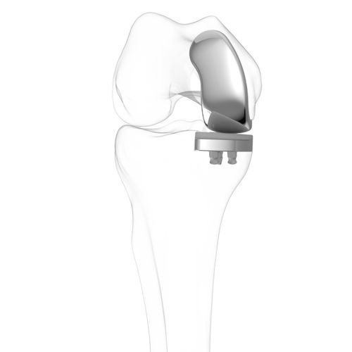Prótesis de rodilla unicompartimental - iUni®  - ConforMIS - de platillo fijo / cementada