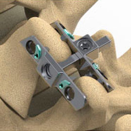 Implante vertebral interespinoso lumbar - Reli™ SP - Precision Spine - sacro / torácico