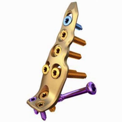Placa de compresión para peroné - ORTHOLOC™ - Wright Medical Technology - porción distal / bloqueada / no bloqueada
