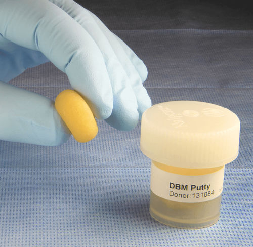 Sustituto óseo alotrasplante - AlphaGRAFT®  - Alphatec Spine - para cirugía ortopédica / maleable