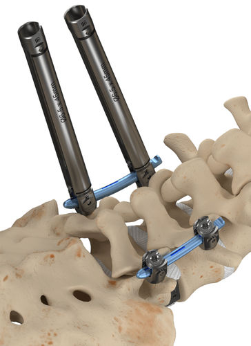 Sistema de posicionamiento de tornillos pediculares mínimamente invasivo - Invictus™ - Alphatec Spine