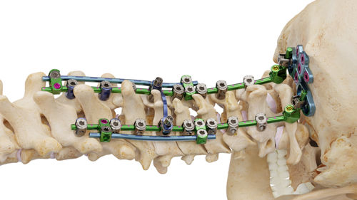 Sistema de osteosíntesis occipitocervicotorácico - Invictus® OCT - Alphatec Spine - vía posterior / para adulto